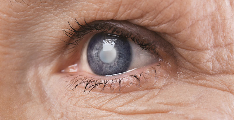 Squamish Cataracts Treatment