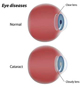 Cataracts Eye Doctor in Burnaby