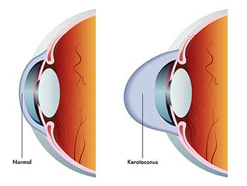 Eye Doctor in Burnaby